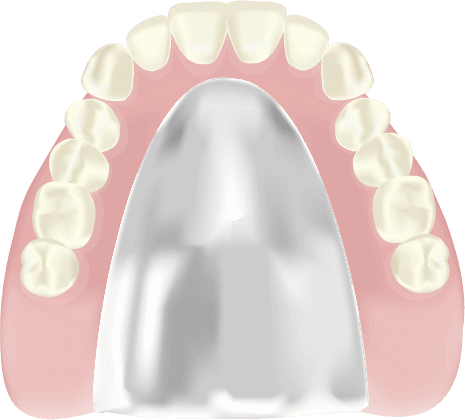 コバルトクロム床義歯