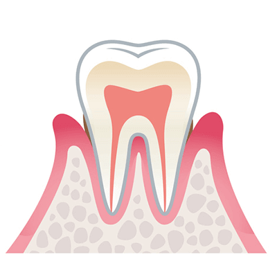 歯肉炎