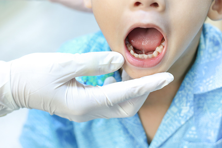 小児口腔機能不全症